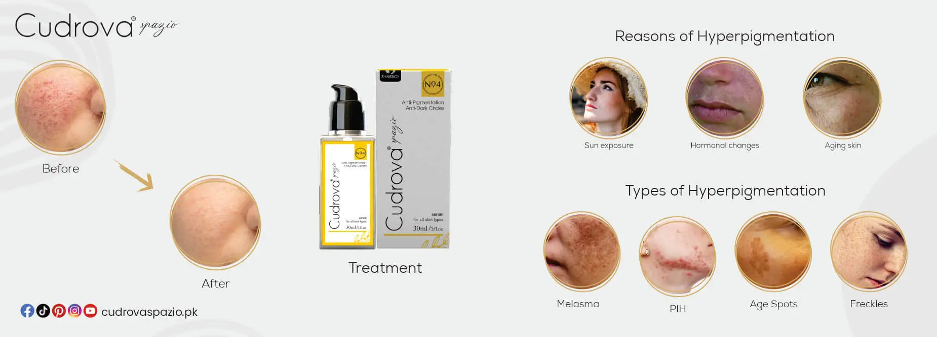 What is Hypigmentation